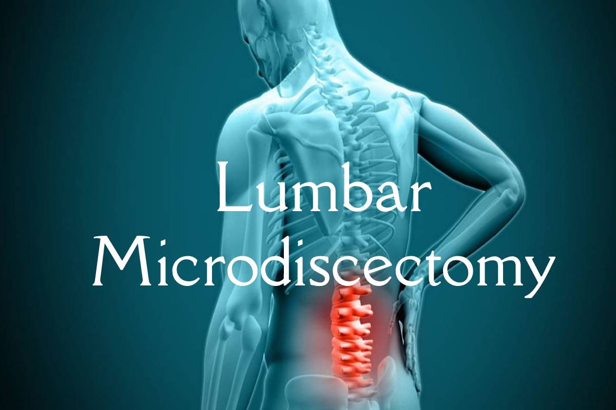 Lumbar Microdiscectomy